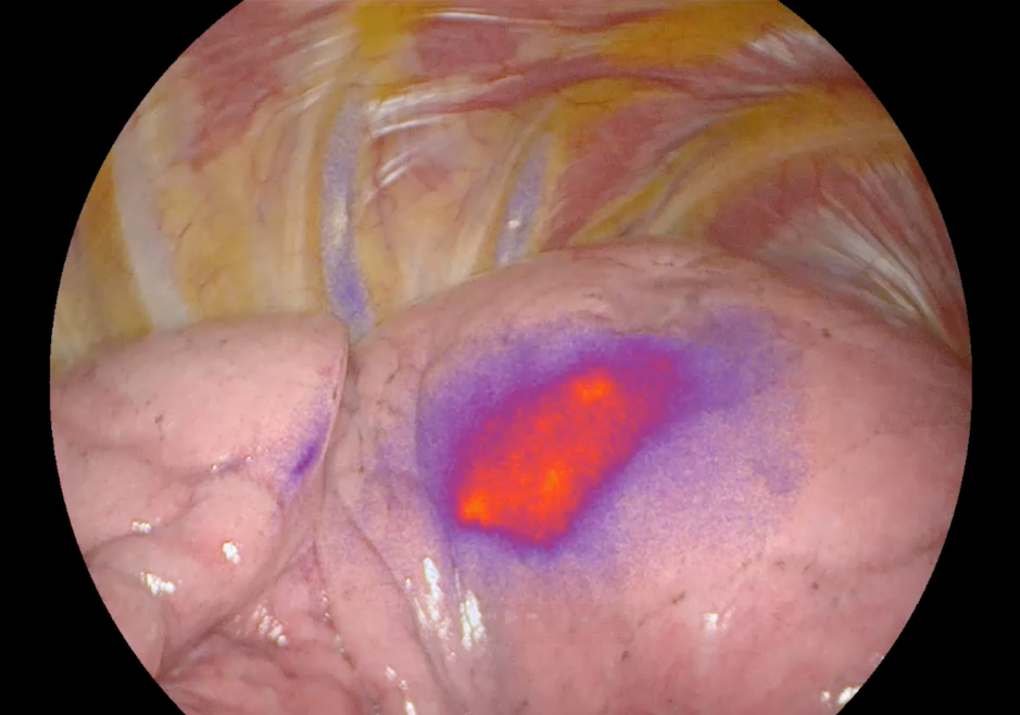 Lung tumor localization using abenacianine with NIR