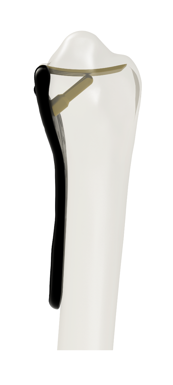 Lever Action Plate in bone, side view